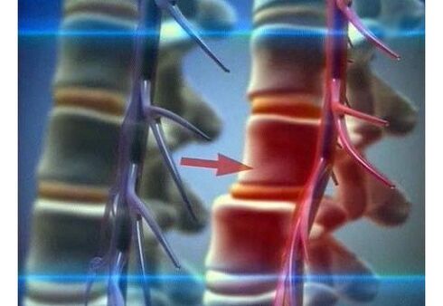 Gerrialdeko osteokondrosiaren nerbio-bukaerak estutzea