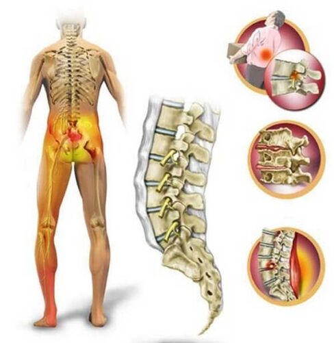Lumbar bizkarrezurraren osteokondrosia, bizkarreko mina eragiten duena