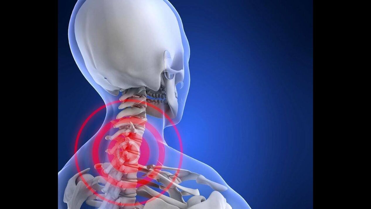 Bizkarrezurreko bizkarrezurraren osteokondrosia