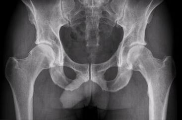 Hip-artikulazioaren artrosiarentzako diagnostiko aukerak