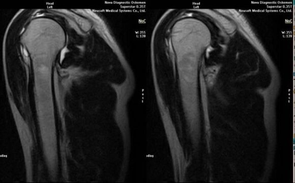 sorbaldako artrosia diagnostikatzeko erradiografia