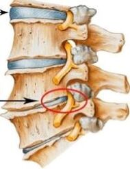 bizkarrezurra zerbikalaren osteokondrosia