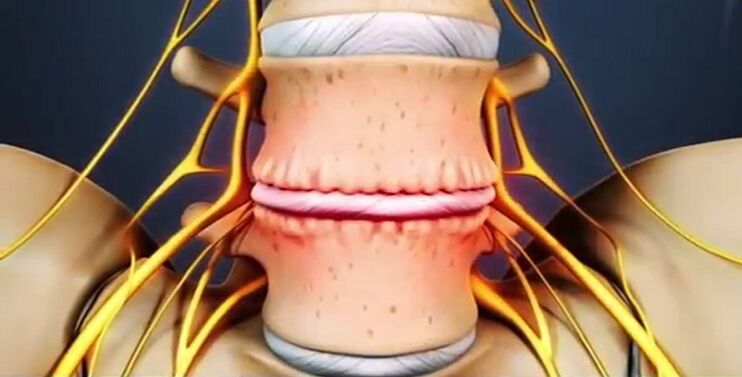 osteokondrosiaren ondorioz bizkarrezurreko lesioak